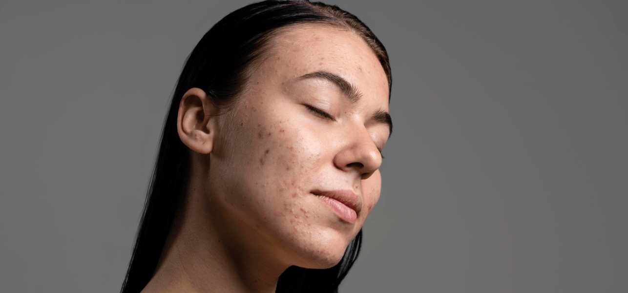 Acne causes, symptoms and customized treatment